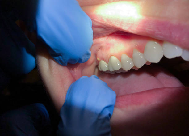 Best Root Canal Emergency Dentist  in Amesti, CA
